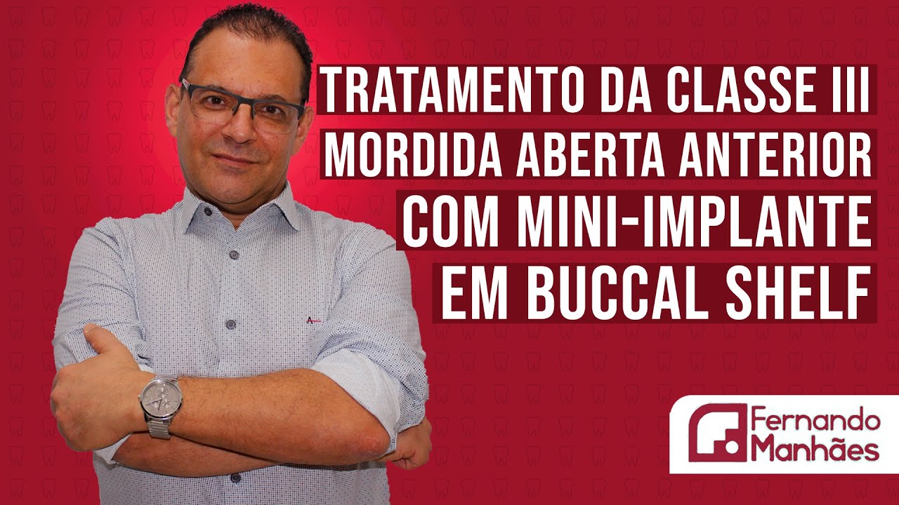 TRATAMENTO DE CLASSE III MORDIDA ABERTA ANTERIOR COM MINI-IMPLANTE BUCCAL SHELF - FERNANDO MANHÃES