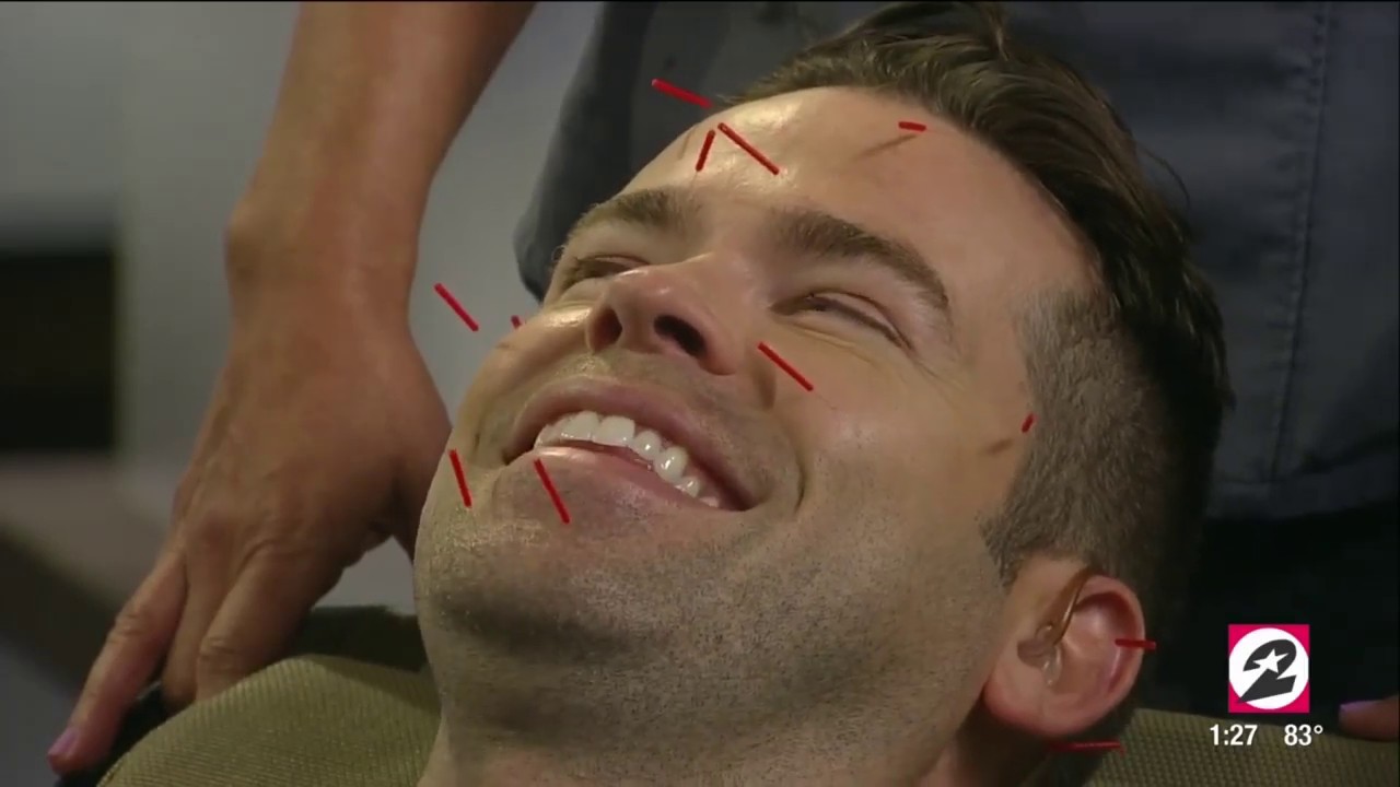 What You Should Know About Facial Acupuncture