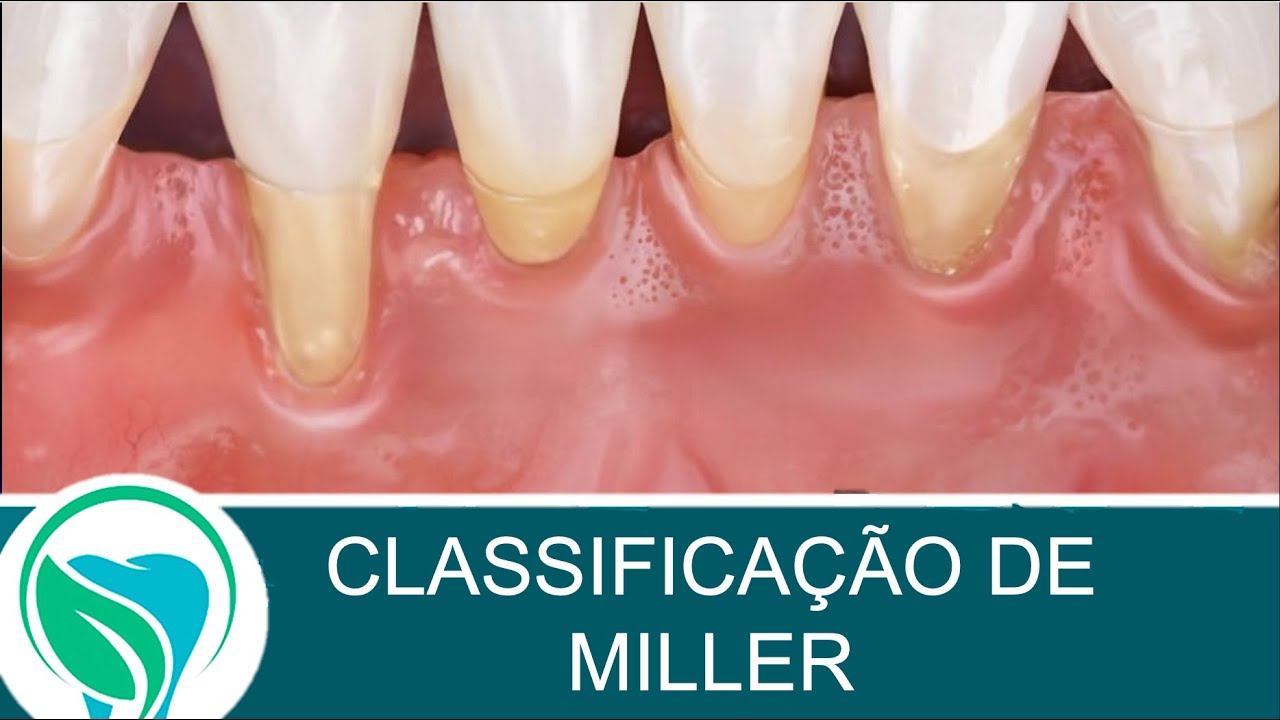 Classificação e prognóstico das recessões gengivais