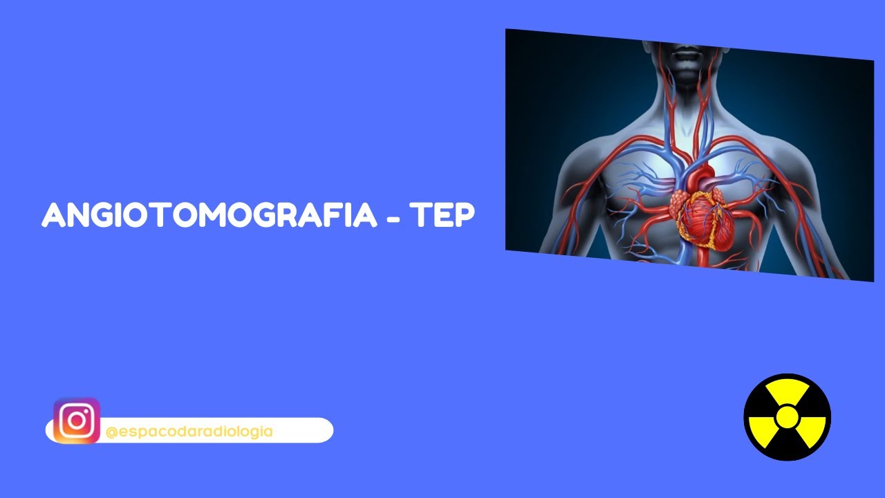 [ANGIOTOMOGRAFIA]: Angiotomografia para diagnóstico de TEP - Trombo embolia pulmonar.