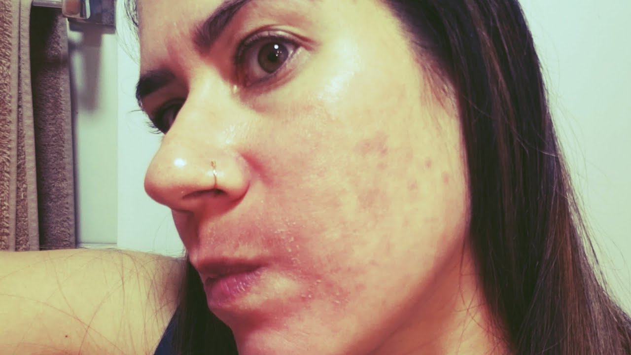 Vitacid Acne e pele queimada