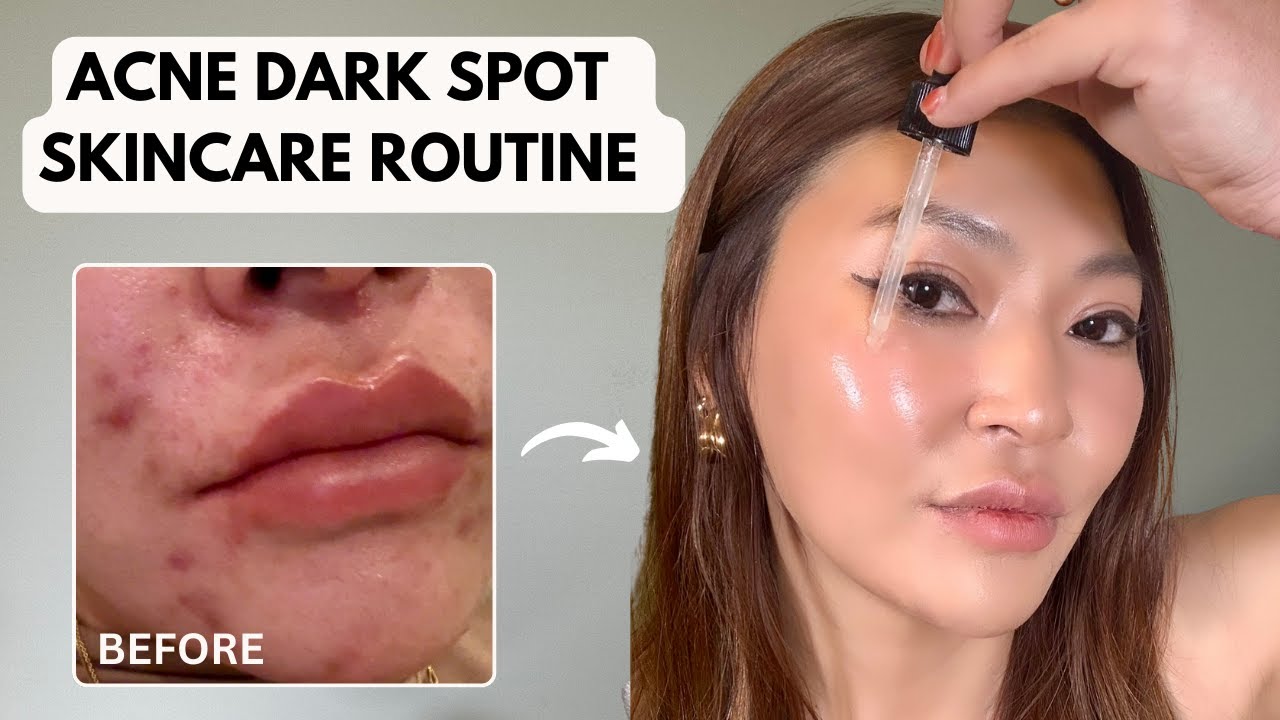 Dark Spot & Hyperpigmentation Skincare Routine | Get Rid of Dark Spots From Acne