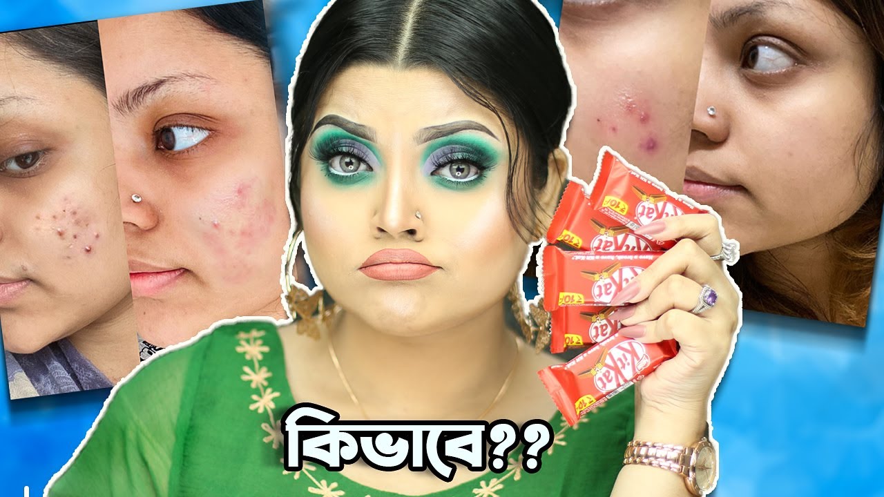 These 5 products will take care of your *ACNE*