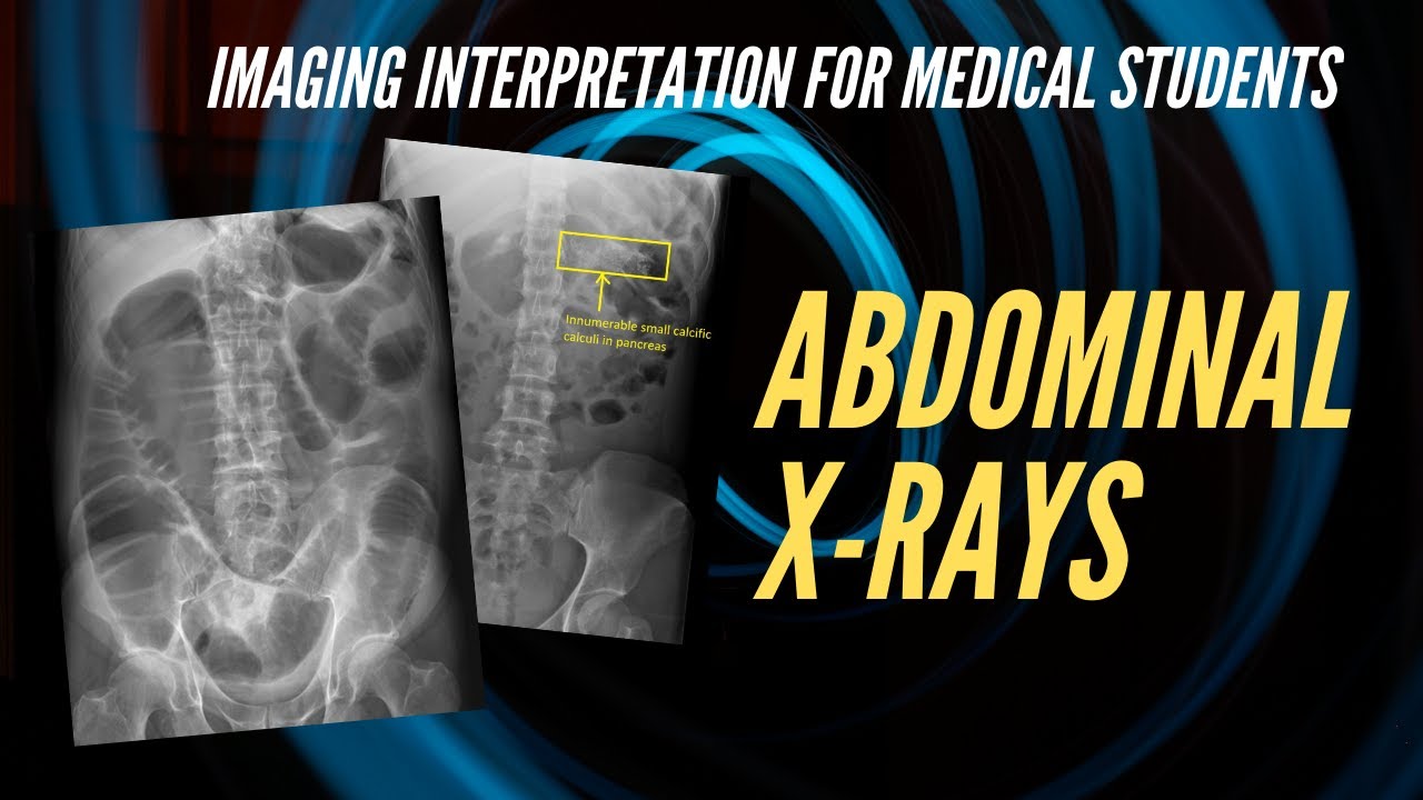 Abdominal X-ray Interpretation for Medical Students