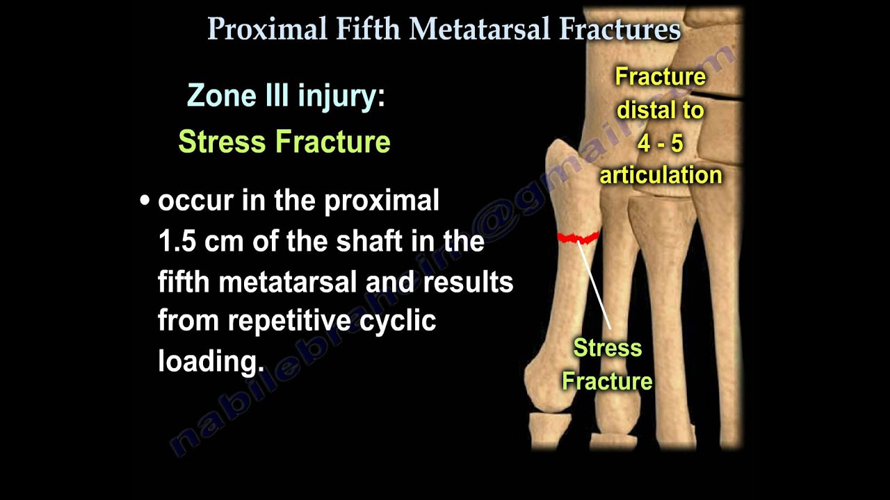 Proximal Fifth Metatarsal Fractures - Everything You Need To Know - Dr. Nabil Ebraheim