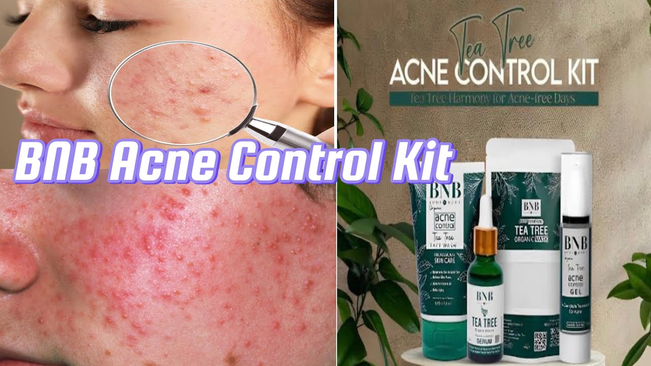 BNB Acne Control Kit Honest Reviews | how to use daily, night nd weekly￼  by Anum Ammar🥰￼