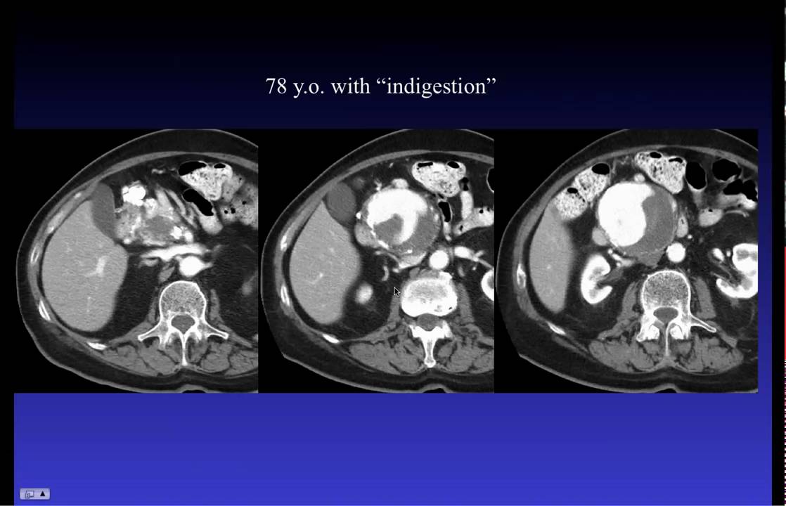 How to choose an embolic agent by William Rilling MD Part 1.mov