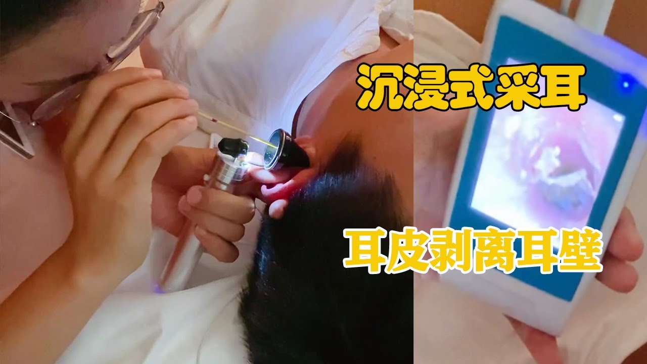 【沉浸式采耳】耳皮剥离耳壁太美妙， 止痒清洁舒心又舒服！#采耳的故事