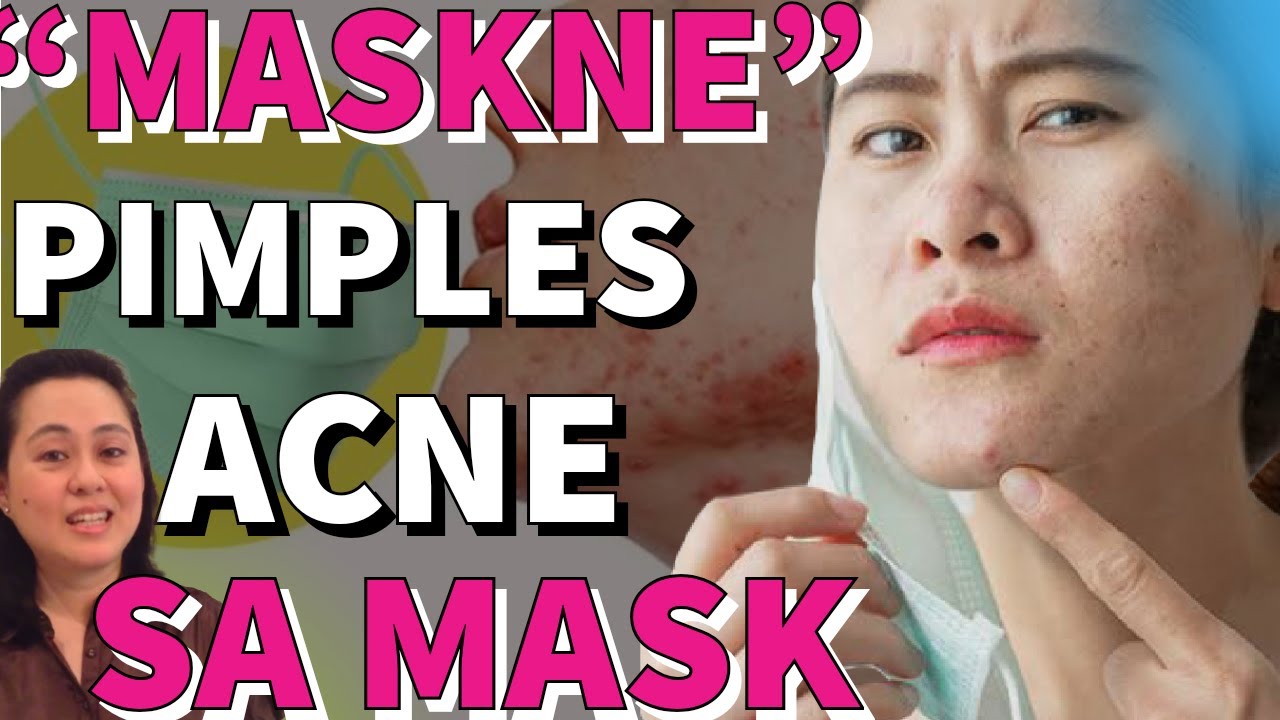 MASKNE: Pimples o Acne sa Mask - by Doc Liza Ramoso-Ong #405