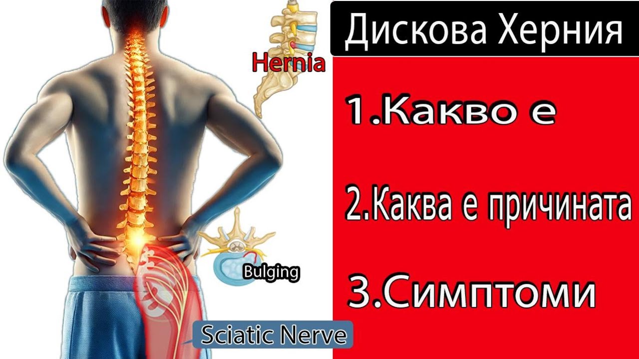 Защо всъщност се появява дискова херния? Ето причината!