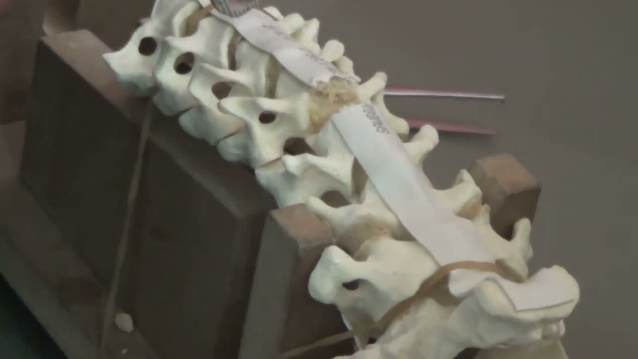 APSS Workshop: Anterior Cervical Discectomy and Fusion ACDF (4)