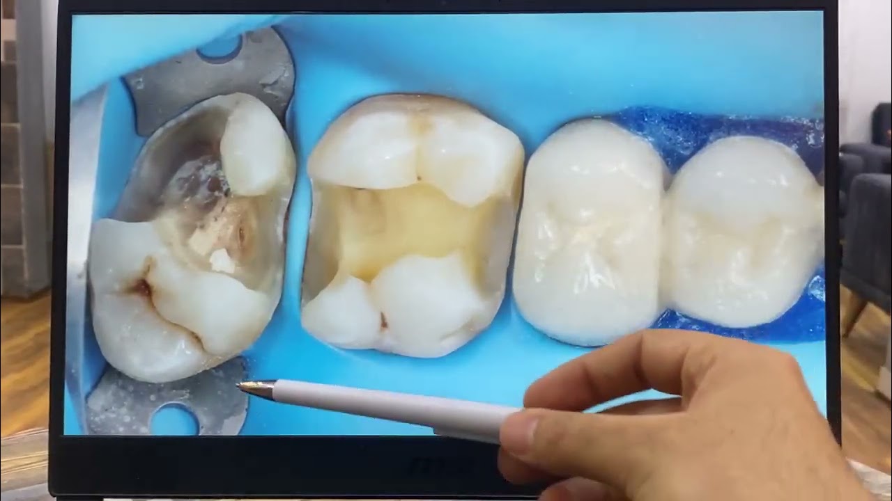 Posterior composite (Cases Discussion)   || Dr.hassan hikmat