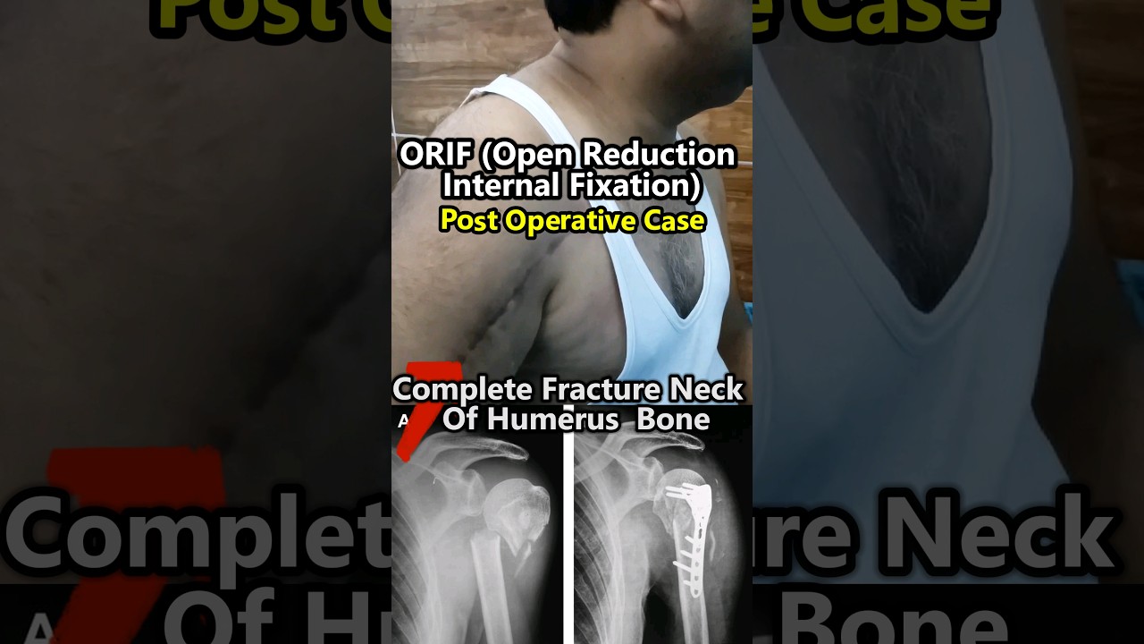 🥺😭 Wait for Results | Humerus Bone Fracture #physiotherapy #aprc  #postoperative #inspiring