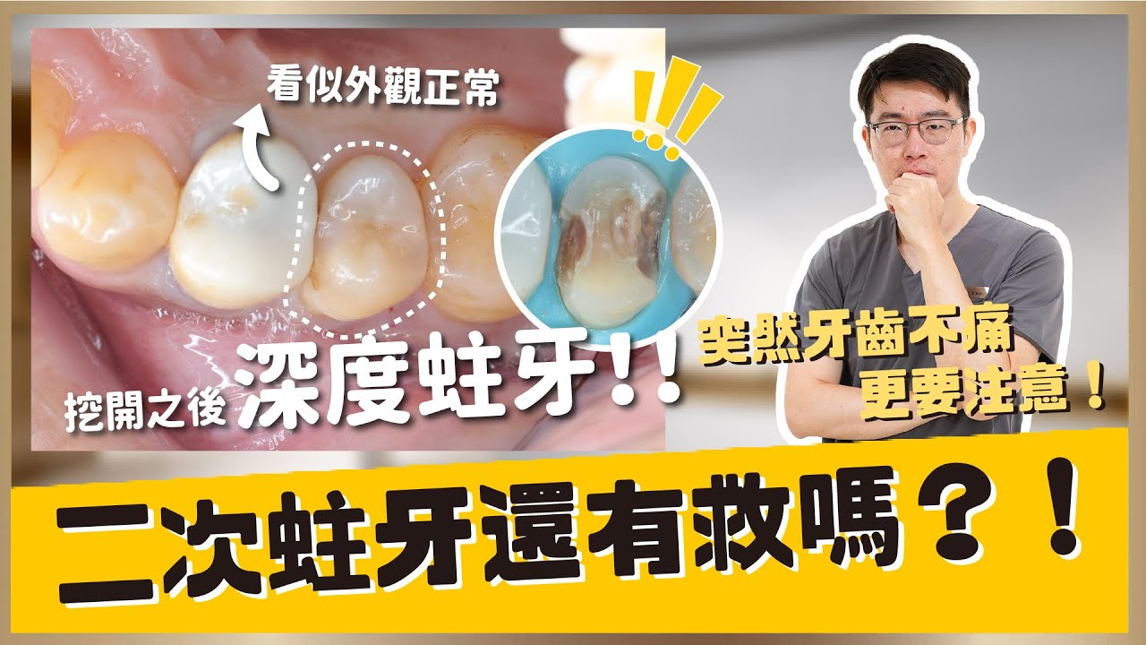 【蛀牙 #8】補牙完二次蛀牙該怎麼辦？為什麼補過又蛀掉！！牙齒還有救嗎？二次蛀牙怎麼治療？如何預防二次蛀牙？｜【祐民牙醫－隱適美旗艦店】鑽石級楊大為醫師 #活髓治療術 #根管治療 #抽神經