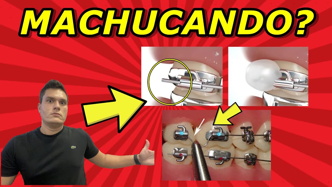 FIO DO APARELHO SOBRANDO E MACHUCANDO A BOCHECHA O QUE FAZER? | DA PRA AJEITAR EM CASA?