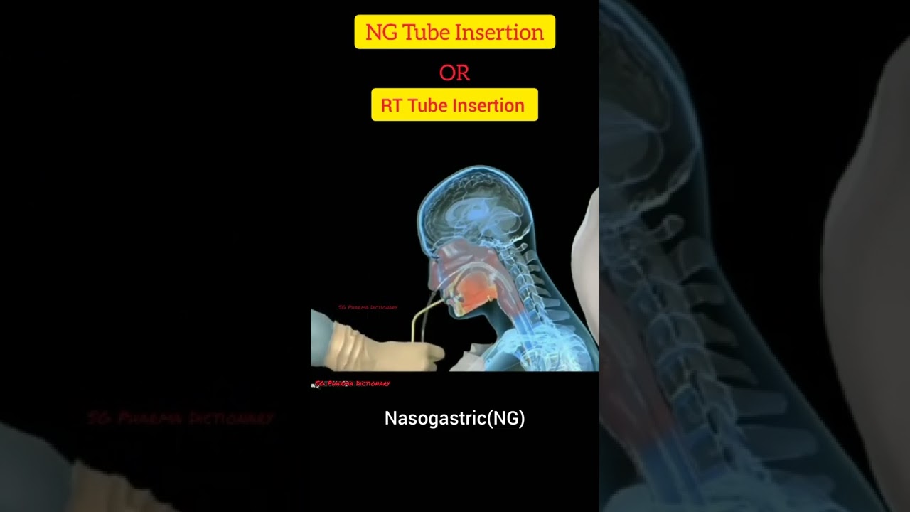 NG ( Nasogastric ) Tube Insertion Techniquen In Hindi  ll RT Tube Insertion Procedure ll SG Pharma