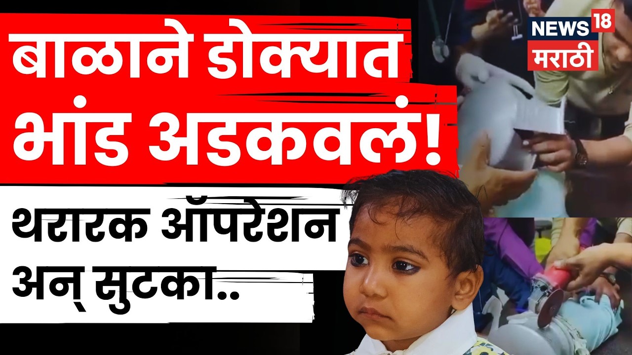 Jalgaon News | बाळाकडे थोडंसं दुर्लक्ष आणि तारेवरची कसरत! डॉक्टरांनी कसं वाचवलं? बघाच | N18V