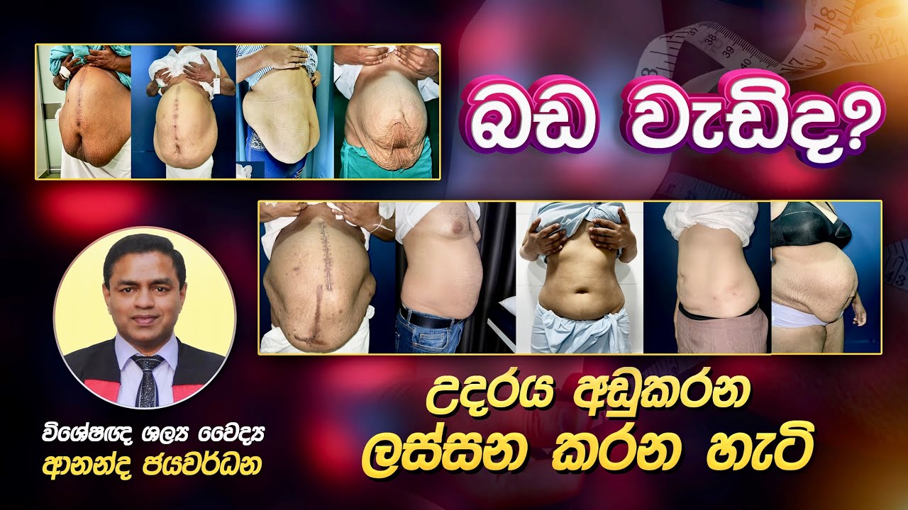 බඩ උදරය අඩු කරන ලස්සන කරන හැටි Bada udaraya Abdomen Tummy best operation  Dr Ananda Jayawardena Sexy