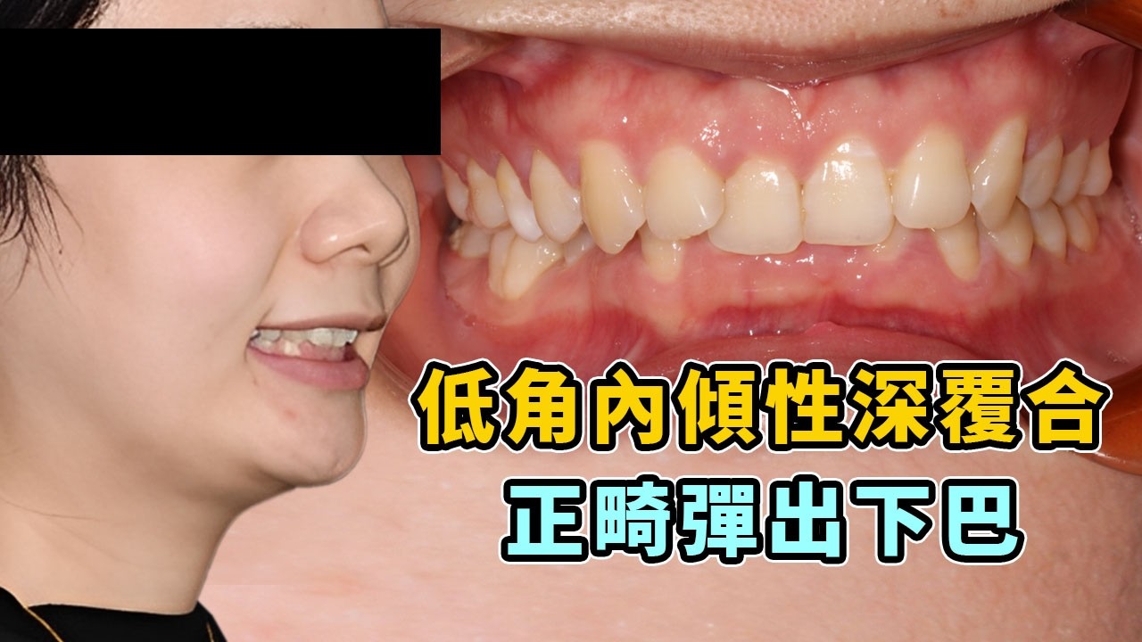 【低角內傾性深覆合女生】如何靠正畸提升顏值？