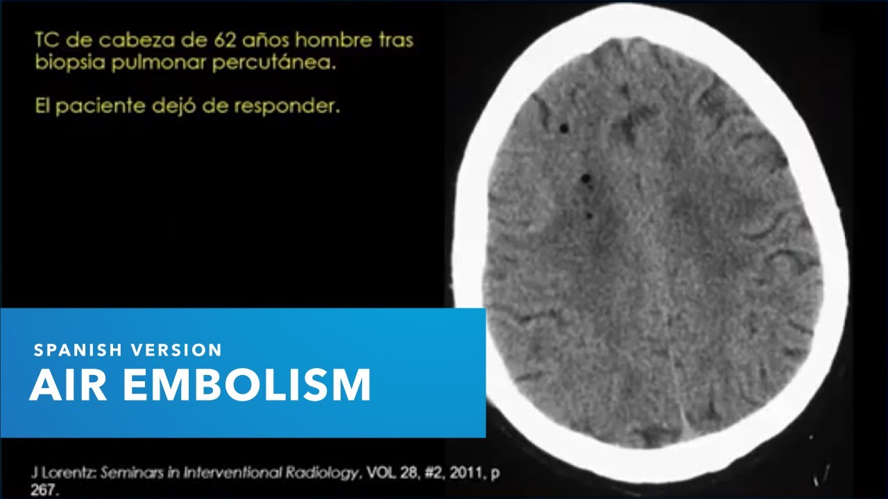 Prevención y detección de la embolia gaseosa con el Dr. Steve Barker, MD, PhD (versión en español)