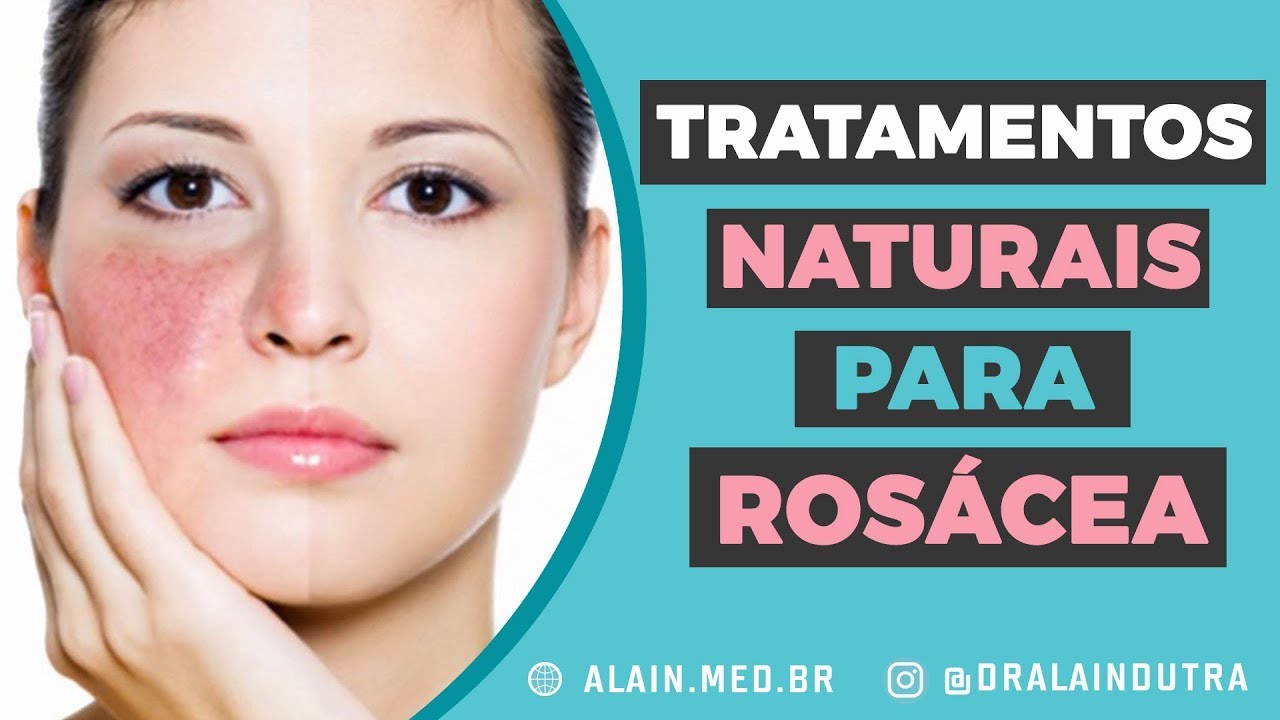 Conheça os tratamentos naturais da rosácea