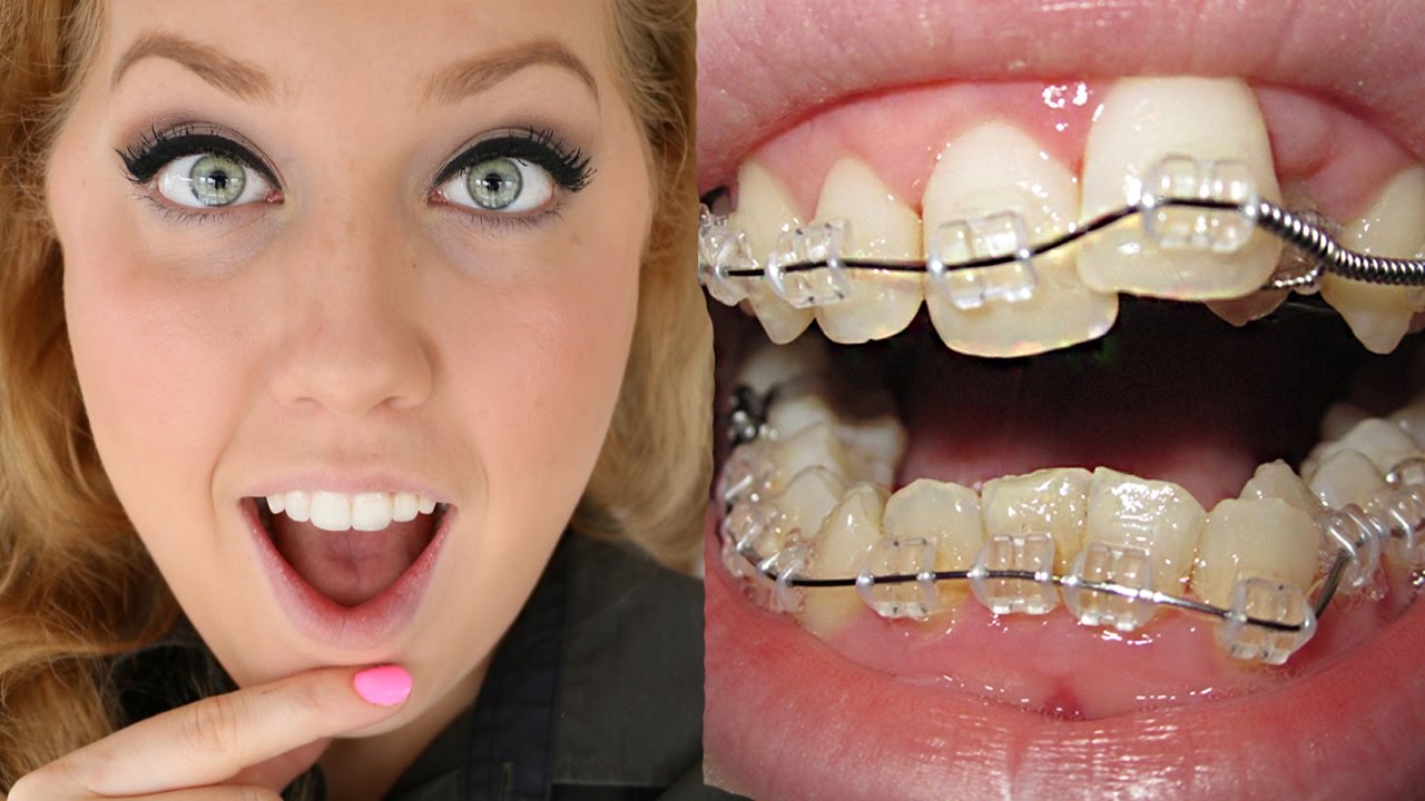 Braces Before And After | Timelapse Transformation | Ashley Craig