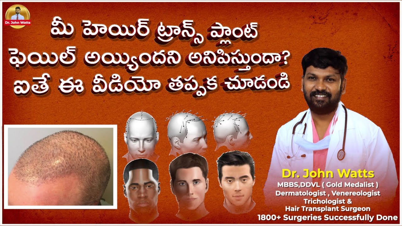 మీ హెయిర్ ట్రాన్స్ ప్లాంట్ రిజల్ట్ విఫలమైందని భావిస్తున్నారా? | Repair Hair Transplant | Dr.John. W
