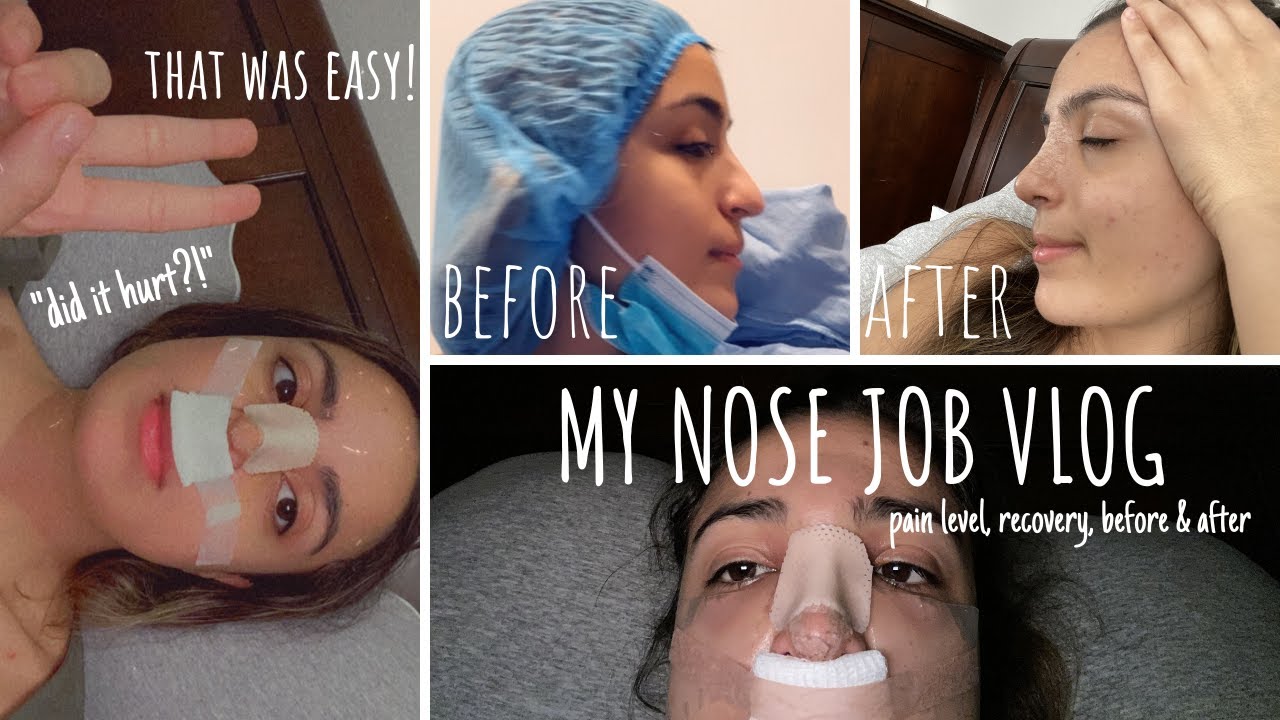 Rhinoplasty Vlog | My Nose Job Experience *EASY!*