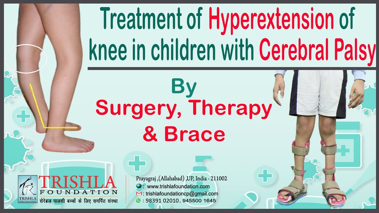 Cerebral Palsy Children with Hyperextension of Knee: Treatment by Therapy, Brace, Surgery at Trishla