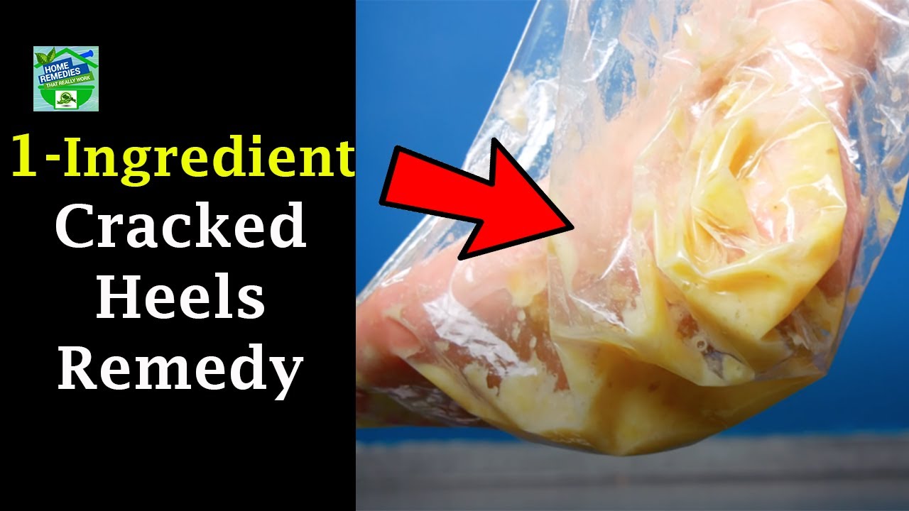 1 Ingredient Cracked Heels Remedy || Magical Cracked Heels Home Remedy