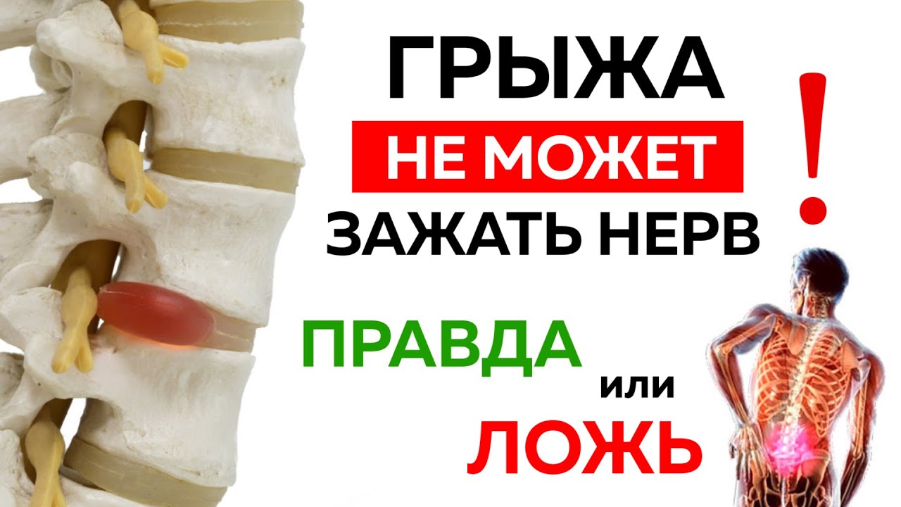 Межпозвонковая грыжа. Корешковый синдром - правда или ложь? Вся правда о грыжах и лечении