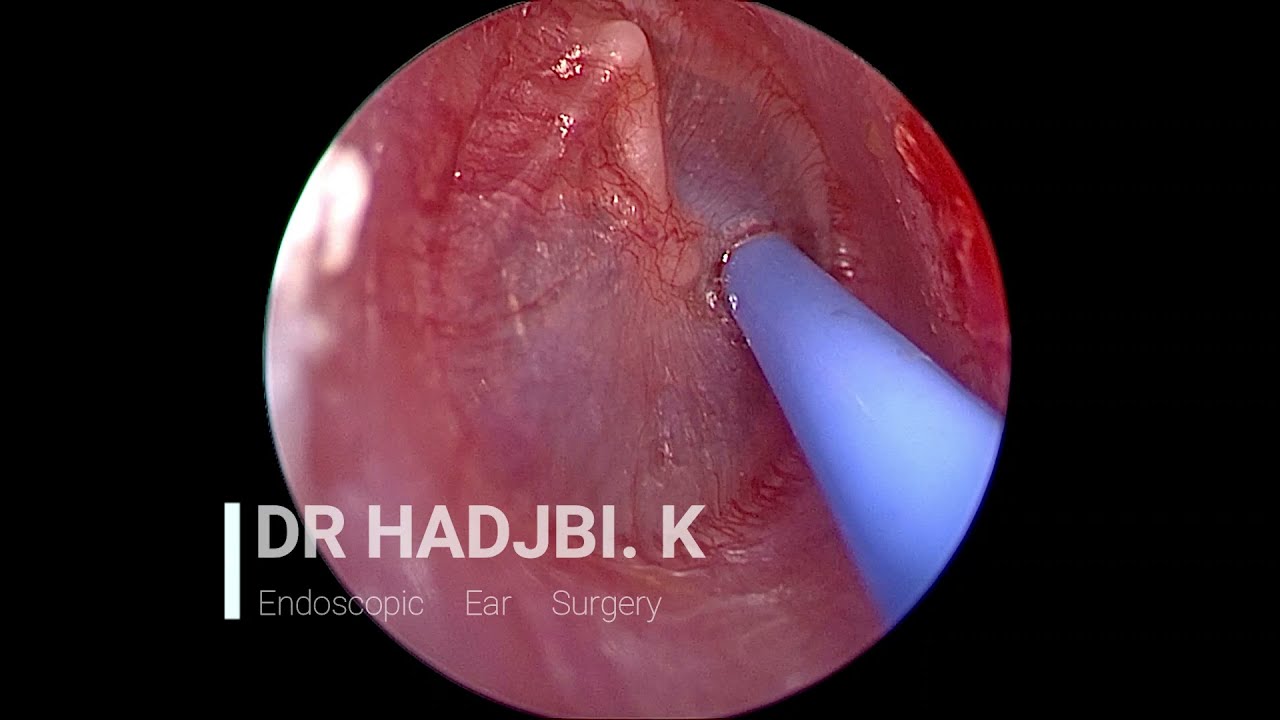 A&eacute;rateur ''drain'' transtympanique sous endoscopie - otite seromuqueuse