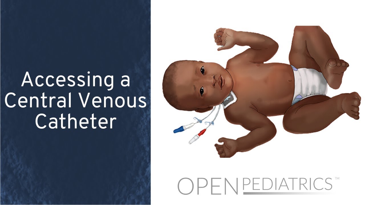 Доступ к центральному венозному катетеру (М. Мэннинг) | OPENPediatrics