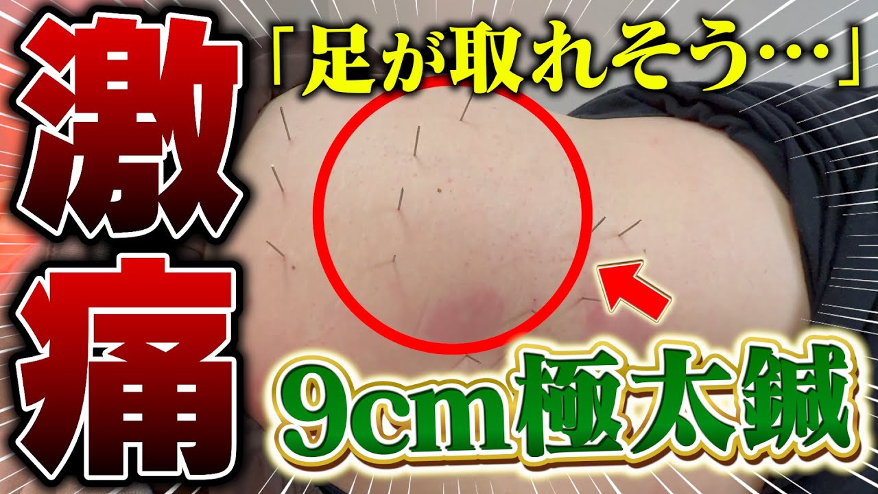 「足が取れそう…」歩けない女性を9cm極太鍼で撃退【腰椎ヘルニア】