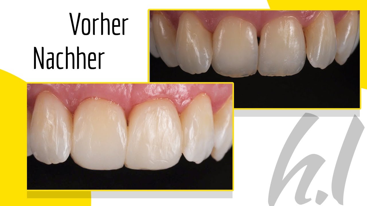 Komposit Veneering bei stark verschachtelt stehenden Zähnen - Dr. Hanni Lohmar