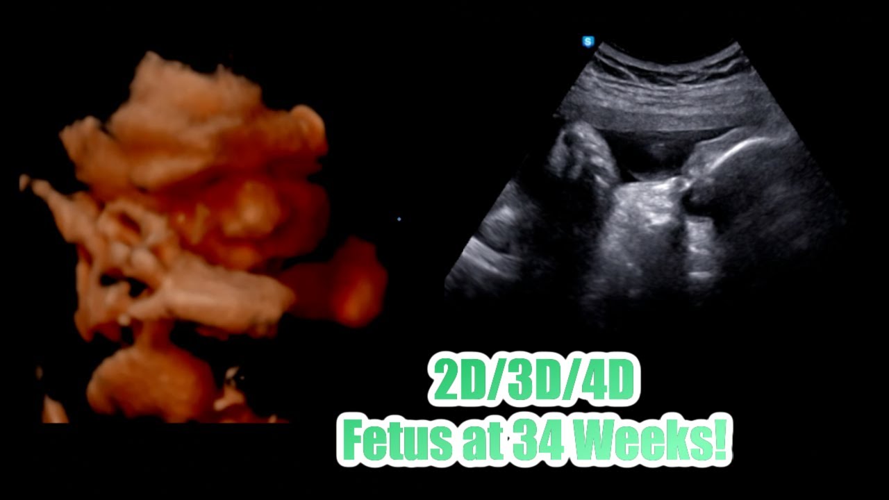 2D/3D/4D Ultrasound at 34 weeks pregnancy