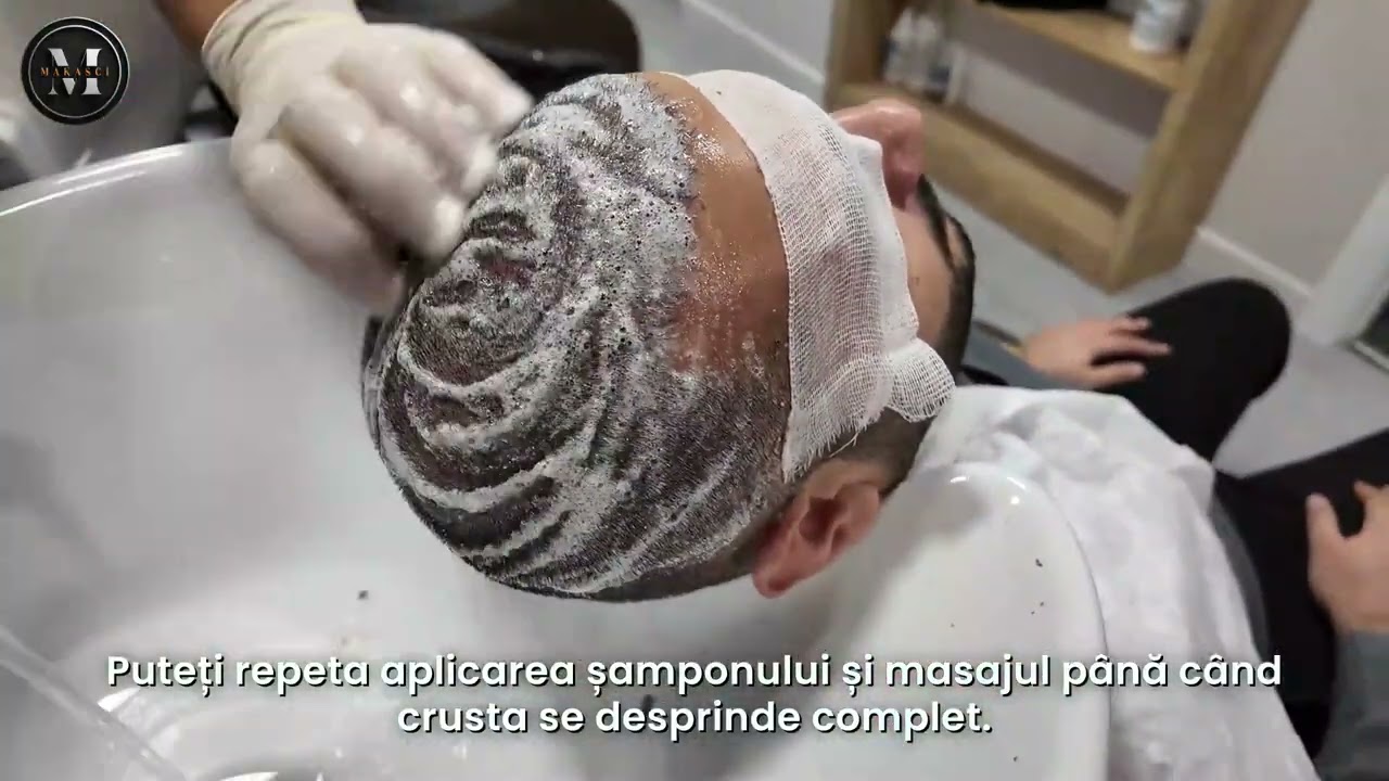 Ziua 10 – Spălarea pentru Îndepărtarea Crustelor: Cum se Face? | Murat Makascı Saç Ekim Merkezi