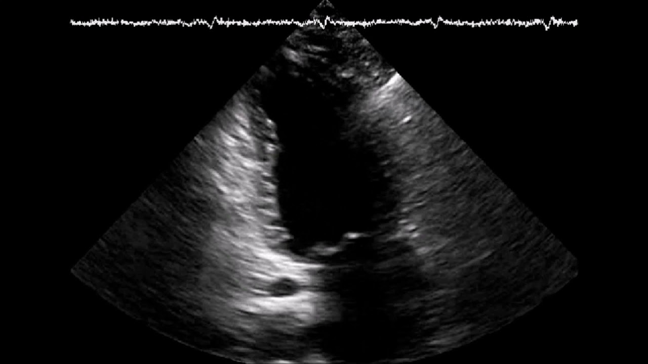 Cardiotoxicity from chemotherapy (cardio-oncology) An echocardiography case and discussion