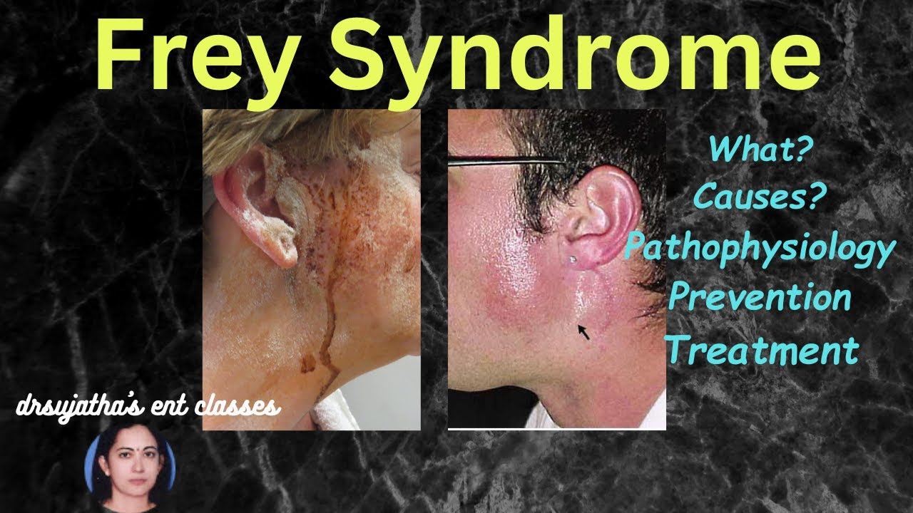 226. Frey's Syndrome: Information Prevention Treatment Explained  #dentallectures