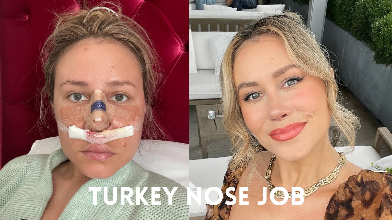 Rhinoplasty in Turkey | Nose Job VLOG