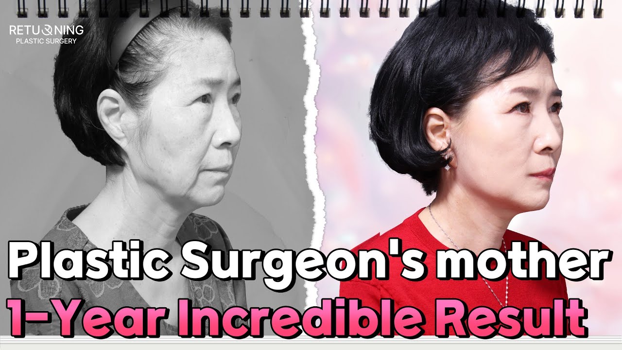 Plastic Surgeon's mother: 1-Year Incredible Result