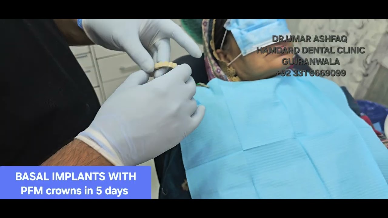 BASAL  HYBRID IMPLANTS ON  RESORBED BONE WITH OUT ARTIFICIAL BONE GRAFTING IN 5 DAYS