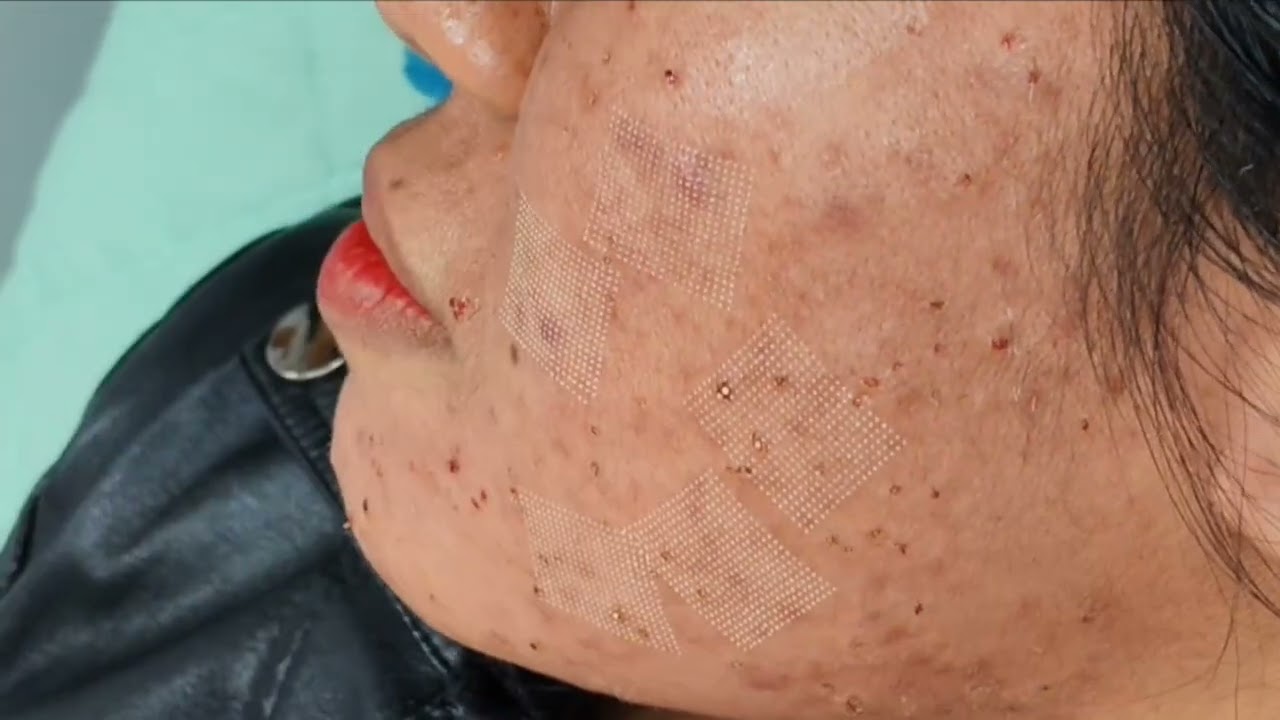 CO2 FRACTIONAL LASER ATASI PORI-PORI BESAR BEKAS JERAWAT SCAR BOPENG