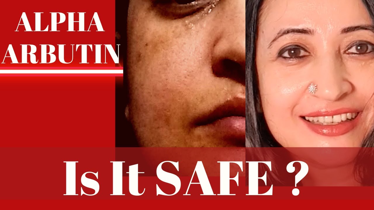 Is Alpha Arbutin Safe in Skin care and Body care? Should you stop it After 3 months?