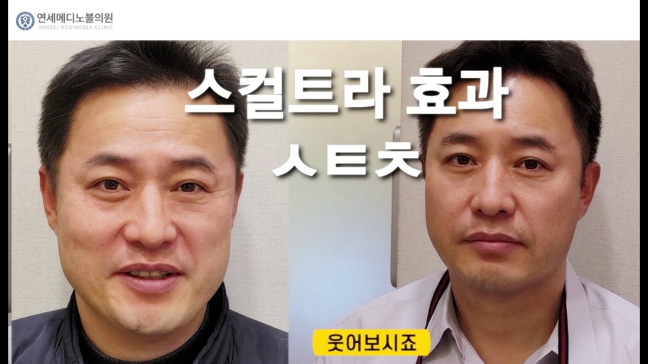 스컬트라 3차 시술장면-50대 남성