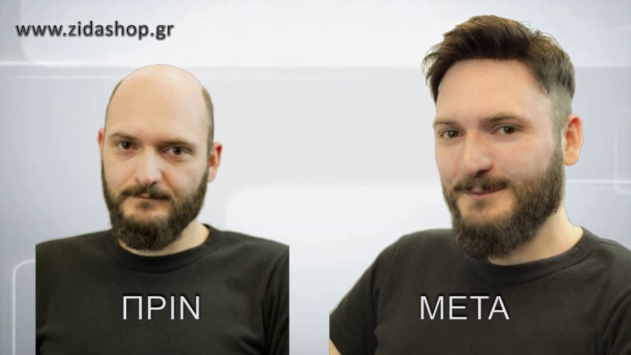 Τουπέ και συστήματα πρόσθετων μαλλιών