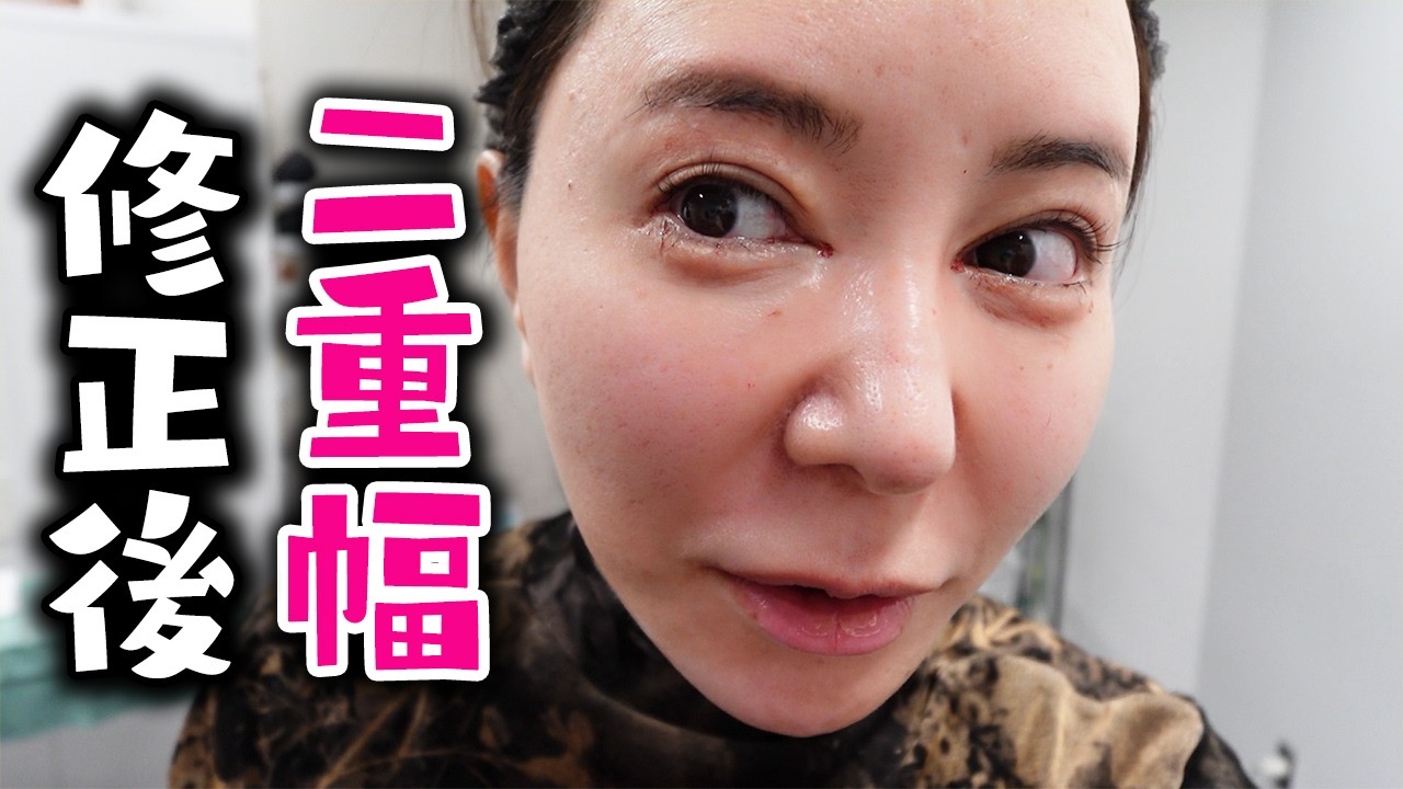 フェアクリニックで二重の幅修正しました