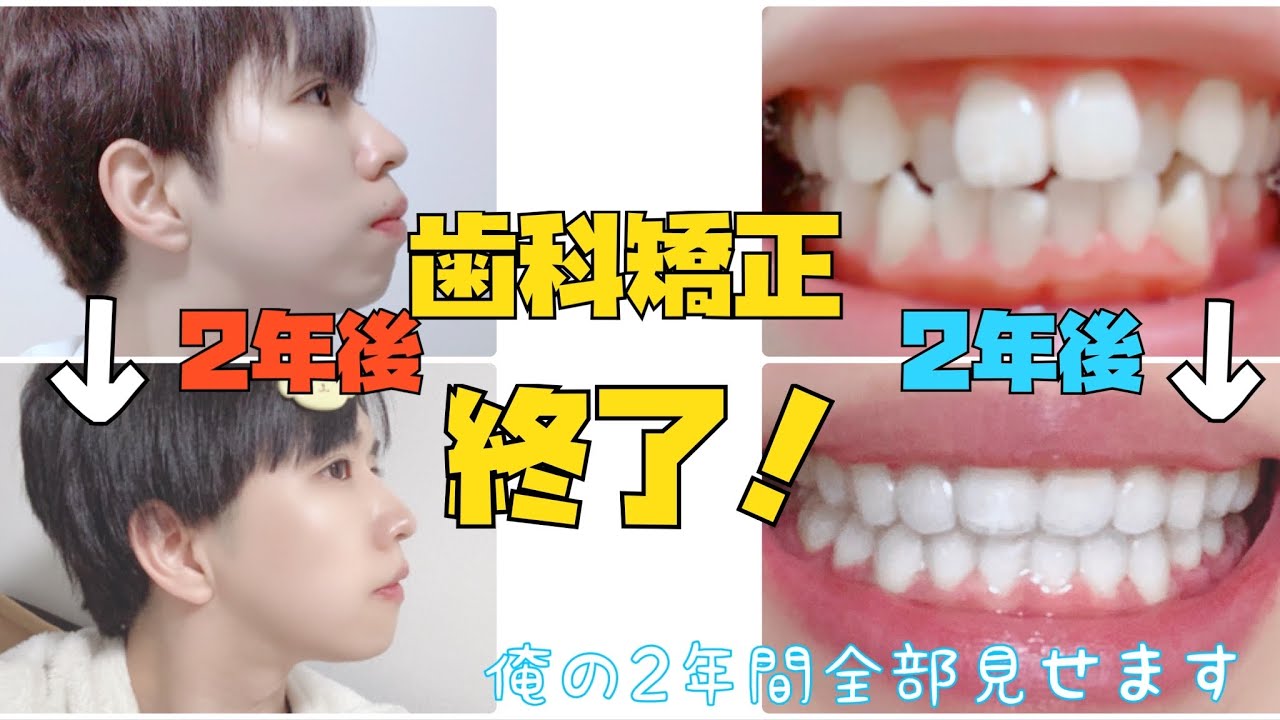 【歯科矯正】終わりました！整形するより顔変わった。【2年間全部見せます】