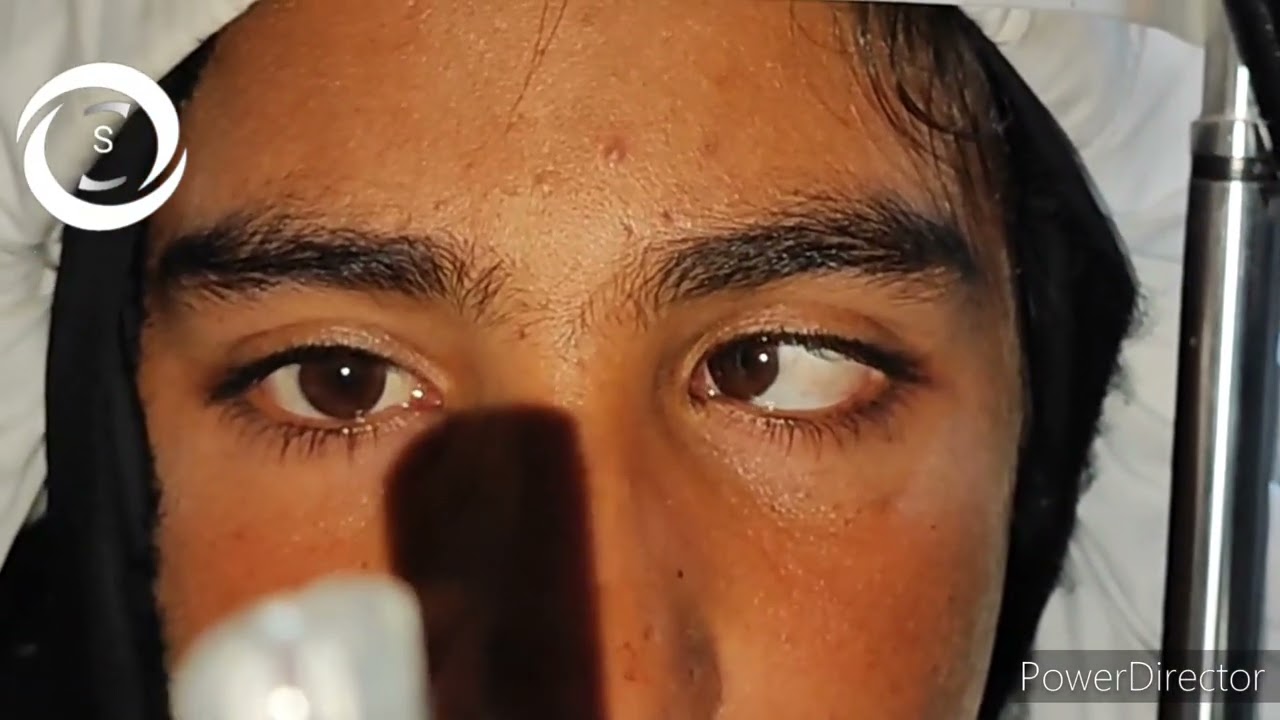 Ophthalmic Signs 209