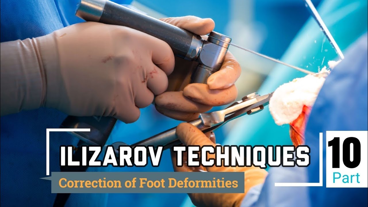 Ilizarov Techniques Worckshop | Part 10 | Foot Deformities Correction by Alexander Kirienko .